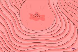 Image result for Acute Cervicitis