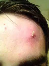 14 Pimple Popping Posts That Ll Gross You Tf Out Pimple Popping Pimples Zit Popping Videos