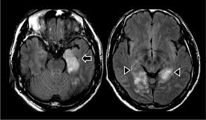 But changes are not specific for hsv (e.g. Case Report