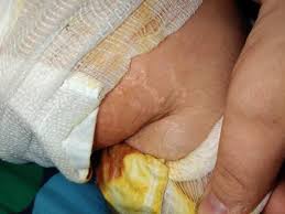 Sepsis is an extreme bodily response to infection, in which inflammation throughout the body can lead to organ damage and even organ failure. Mein Bein Ist Am Einen Morgen Dick Aufgeschwollen Trombose Oder Sepsis Oder Was Ist Das Gesundheit Und Medizin Gesundheit Beine