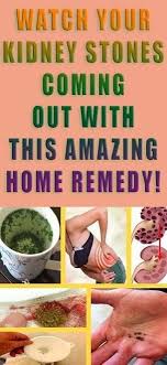 Watch Your Kidney Stones Coming Out With This Amazing Home Remedy Health Healthy Health Health Remedies