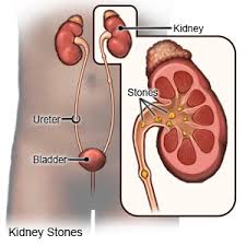 Kidney Stones Discharge Care What You Need To Know
