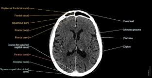 Image result for CT Head
