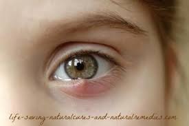 Guaranteed Way To Get Rid Of An Eye Stye Fast At Home Here S The Best Home Remedy For A Sty You Ll Come Acros Eyes Problems Eye Stye Remedies Stye Treatment