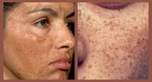 Apply 5 drops of oil on face and neck before sleeping in a circular motion. Natural Melasma Treatment In Ayurveda Melasma Treatment In India