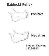 Image result for Babinski Reflex