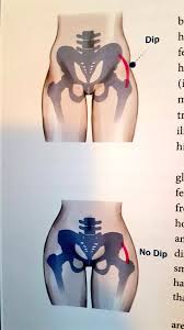 Rosa Carbo Mascarell En Twitter Recuerdo Que Los Hip Dips Son Causados Por La Estructura De Los Huesos No Por Grasa O Musculo De Hecho Si Tienes Menos Grasa Corporal Los Hip Te explicamos los mejores trucos, remedios caseros y consejos. recuerdo que los hip dips son causados