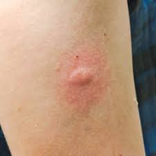 Image result for mosquito bite
