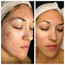 Apr 16, 2020 · 61% reported either a complete clearing of their rosacea or a significant reduction in the number of papules and pustules after 12 weeks of treatment if no improvement is seen within 4 to 8 weeks talk to your doctor. Azelaic Acid 20 Whitening Remove Dark Spots Rosacea Acne Spots Azeclear Cream Skin Whitening Treatment Of Darker Skinned Bb Cc Creams Aliexpress