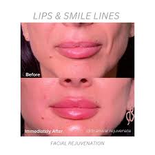 Want to know the secret to this Transformation? Full Facial Rejuvenation  for our beautiful patient❤️, Dr.Anwar Al-Khalil treated the Nasolabial  folds with a Suitable filler💉for shadow correction & ...