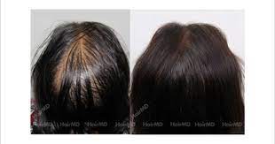 Prp Therapy For Hair Loss Results Before And After Fue Hair Transplant Hair Loss Women Hair Therapy