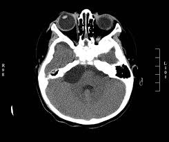 Menawarkan berbagai prosedur otologis termasuk otoplasti, timpanoplasti, mastoidektomi dan pengangkatan tumor sudut serebelopontin. Cerebellopontine Angle Cancer Article
