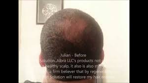 Additionally, the problem may improve with getting adequate exposure to the. Eczema Psoriasis And Seborrheic Dermatitis And Thinning Hair Testimonials From Albra Llc Youtube