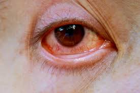 Image result for Vernal Conjunctivitis