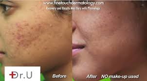 There is minimal downtime with some redness after treatment for 48 hours. Fraxel Dual Acne Scar Treatment African American Skin