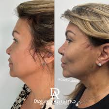 Neck Lift & Décolleté