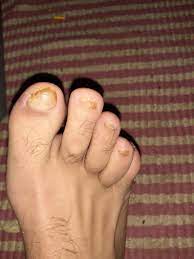 We did not find results for: Going To The Podiatrist Was A Waste Of Money They Told Me They Had To Send A Sample Of My Nail To Confirm It Was Fungus When It Was Obviously Fungus Got