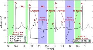 Image result for P Wave