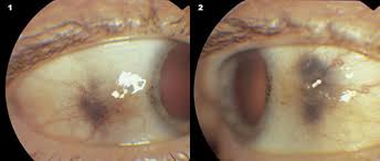 Image result for melanosis sclera