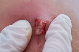 Abszess: Behandlung, Versorgung von Abszessen und Abszesswunden