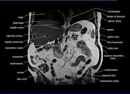 Anatomy Human Abdomen Mri Abdomen Coronal Anatomy Free Cross Sectional Anatomy Mri Pet Ct Anatomy