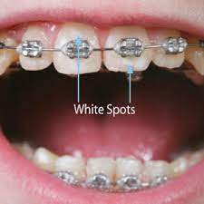 Find out when & how to whiten your teeth to get a whiter smile from the experts at total orthodontics. White Spots On Your Teeth After Braces May Be An Early Sign Of Enamel Loss The Brace Place Orthodontics