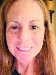 Dealing with recurring eye styes and blepharitis?