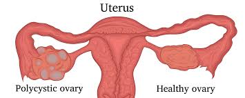 Pcos can cause missed or irregular menstrual periods, excess hair growth, acne, infertility, and weight gain. Polycystic Ovary Syndrome May Be Inherited Epigenetically The Scientist Magazine