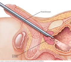 We did not find results for: Transurethral Resection Of The Prostate Turp Mayo Clinic