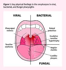 Image result for Pharyngitis