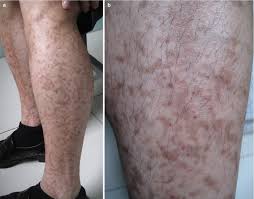 Image result for Diffuse Hyperpigmentation