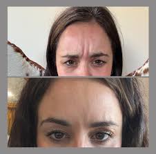 Come take a Botox of filler or body sculpting course with me and start your  new career or even just a side gig Message me for more information or ask  about afterpay