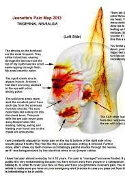 Accurate But For Me This Was On Both Sides And Had A Couple Other Symptoms Trigeminal Neuralgia Trigeminal Neuralgia Treatment Neuralgia