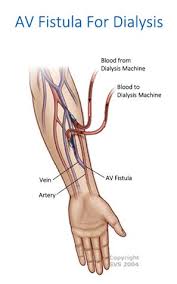 Pin On Av Fistula Surgery Spring Hill Florida