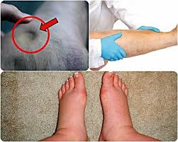 Pin Oleh Acemaxsulul Di Obat Tradisional Kaki Bengkak Kaki