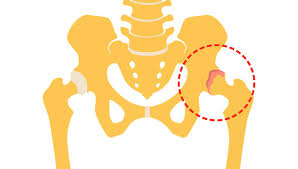 Coxartroza este cauzata de deteriorarea cartilajului articular si uzura articulatiei soldului. Totul Despre Coxartroza Semne Simptome Si Tratament Prin Chirurgie Minim Invaziva Reginamaria Ro