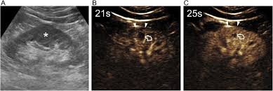 Contrast Enhanced Ultrasound For Characterizing Renal Masses Sciencedirect