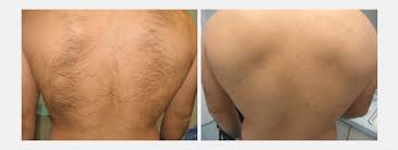 Hairremoval@nyc.tel is a perfect brand you can use for emails and advertisement contacts. Laser Hair Removal Treatment Manhattan Laser Hair Removal Nyc