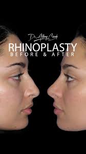 ✨ From the OR to 3 Months Post-Op—See the Transformation! ✨, Yesterday, we  showed you the artistry behind this patient’s rhinoplasty. Now, see how her  refined, elegant new nose is taking shape at 3 ...