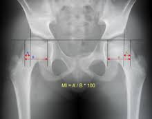 Check spelling or type a new query. Hip Dislocation Wikipedia