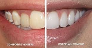 The Complete Guide to Porcelain Veneers | Complete Dental