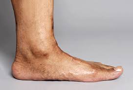 The bump on side of foot should not be taken for granted, since it may possible treatment options for this bump on outside of foot may include a break from physical activities like sports. Why Does My Ankle Hurt 15 Possible Causes Of Ankle Pain