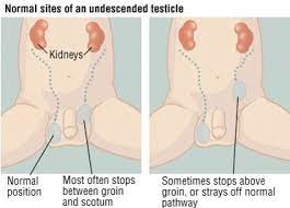 First signs of testicular cancer. Urology Cryptorchidism Testicular Torsion Hydrocele Varicocele Flashcards Quizlet