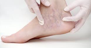 Odem Nedir Neden Olur Odem Vucuttan Nasil Atilir Bitkisel Ve Dogal Tedavisi Nasil Yapilir Saglik Haberleri