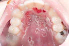 Image result for Oral herpes roof of mouth