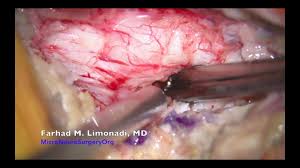 Consultant spine surgeon 3.171 views2 year ago. Spine Surgery Surgical Removal Of A Herniated Disk Resulting In Leg Weakness Youtube