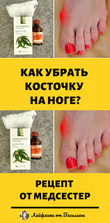 как избавиться от косточки на ноге в домашних условиях Zdorove Zdorove Fakty O Zdorove I Naturalnaya Medicina