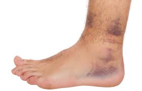 A grade 2 sprained ankle causes moderate pain, swelling of the joint, and some joint instability. How A Diabetic Should Treat A Sprained Ankle Scary Symptoms