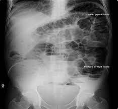 Plain Erect Abdominal Film Showing Markedly Dilated Air Filled Small Download Scientific Diagram