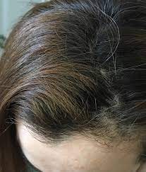 Yabanci Haberler Gercek Kullu Kumral Boyayanlar Aatureks Com